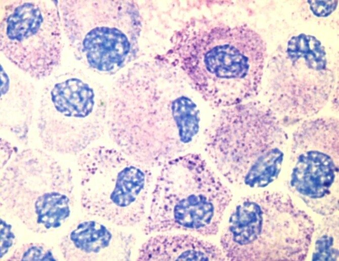 Mast cells may also be involved in infertility, since they are found at high numbers in the mucosal layer of the uterus, i.e. the endometrial tissue. Author: Kauczuk / Wikimedia Commons